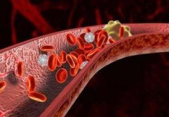 肾静脉血栓是由什么原因引起的？